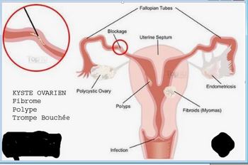 Phimosis Tubaire Solution Naturelle