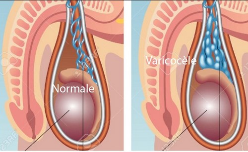 Varicocèle Causes Symptômes Traitement Naturel. Recette Naturelle Varicocèle