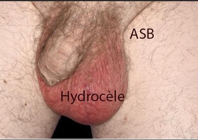 Hydrocèle Testiculaire Causes Symptômes Solution Naturelle