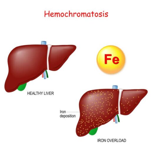 Comment Soigner Naturellement L'Hémochromatose