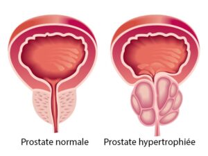 Produit Contre les Maladies de la Prostate 