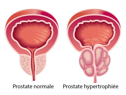 Cancer de la Prostate Solution Naturelle