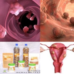 Polype Utérin Causes Symptômes Diagnostics Solution Naturelle