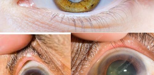 Cataracte Causes Traitement Naturel