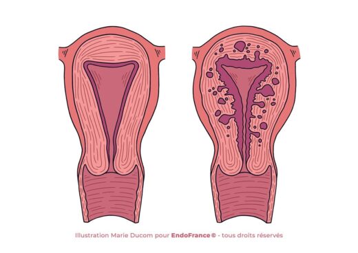 Endométriose Solution Naturelle