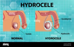 Hydrocèle Vaginale