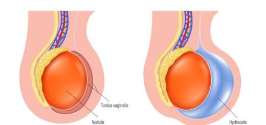 Hydrocèle Vaginale Traitement Naturel