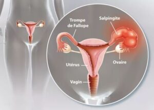 Comment Guérir la Salpingite