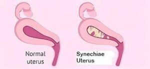 Remède Contre la Synéchie Utérine