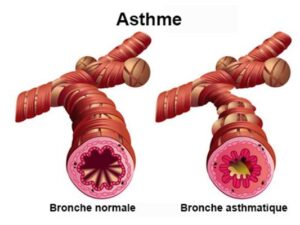 Produit Pour Soigner L'Asthme 