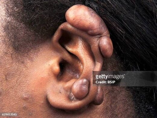 Chéloïdes Solution Naturelle