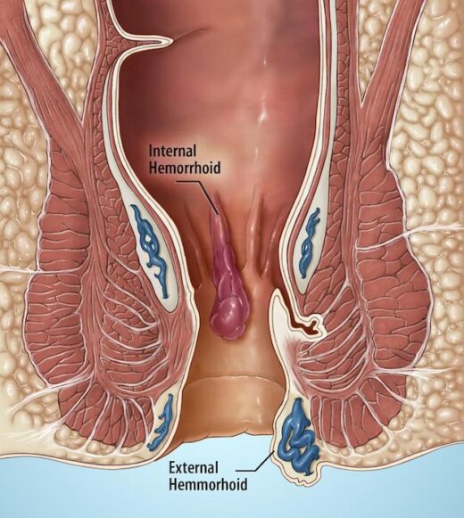 Rectorragie Traitement Naturel