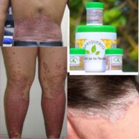 Pommade pour Guérir le Psoriasis Naturellement