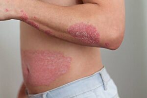 Traitement Naturel de le Psoriasis