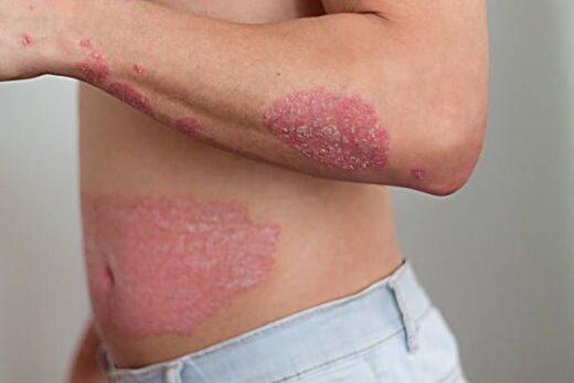 Psoriasis Causes Symptômes Solution Naturelle contre le Psoriasis