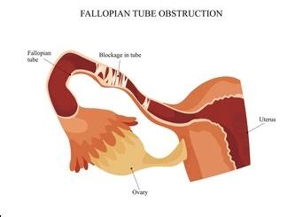 Obstruction Tubaire Traitement Naturel