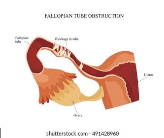 Obstruction Tubaire Traitement Naturel