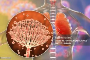 Traitement Naturel de l'Aspergillose. Comment soigner une aspergillose naturellement. Voici un bon Traitement Naturel qui guérit l'aspergillose de façon naturelle avec les plantes antibiotiques. Comment Soigner une Aspergillose de façon naturelle découvrez ici notre super remèdeCliquez ici pour avoir le meilleur remède pour soigner l'Aspergillose Aspergillose Pulmonaire : Traitement Naturel de l'Aspergillose Recherches associées : Aspergillose Pulmonaire Remède Naturel Aspergillose pulmonaire traitement naturel, aspergillose pulmonaire remède naturel, Aspergillose broncho pulmonaire allergique solution naturelle, Diagnostic et traitement de l'aspergillose, Aspergillose bronchopulmonaire allergique remède naturel Aspergillose Remède Naturel Aspergillose, Aspergillose pulmonaire nécrosante chronique solution naturelle, Aspergillose - Symptômes, Diagnostic, Traitement, Risques, l'infection du champignon Aspergillus traitement naturel, Comment guérir de l'aspergillose naturellement, Quel est l'agent causal de l'aspergillose pulmonaire, Comment soigner une infection fongique naturellement, Comment faire disparaître des champignon naturellement L’aspergillose, qu'est-ce que c'est ? L'aspergillose est une infection fongique causée par le champignon Aspergillus. Ce champignon est présent dans l'environnement et se retrouve souvent dans le sol, les débris végétaux en décomposition, et même dans l'air intérieur et extérieur. Dans la plupart des cas, l'aspergillose ne provoque pas de maladie chez les personnes en bonne santé, car leur système immunitaire est capable de contrôler la croissance du champignon. Cependant, chez les personnes dont le système immunitaire est affaibli, comme celles qui ont des troubles pulmonaires sous-jacents ou un système immunitaire compromis, l'aspergillose peut causer des infections graves. Nous joindre ici pour en savoir plus Les différentes types d'aspergilloses : Traitement Naturel de l'Aspergillose 1°Aspergillose broncho-pulmonaire allergique (ABPA) : Il s'agit d'une réaction allergique à la présence d'Aspergillus dans les poumons. Les symptômes comprennent une toux persistante, des difficultés respiratoires, des sifflements et parfois de la fièvre. 2°Aspergillose pulmonaire invasive (API) : C'est une infection grave dans laquelle le champignon envahit les tissus pulmonaires. Les symptômes peuvent inclure une toux sévère, une fièvre persistante, des douleurs thoraciques et une difficulté respiratoire. En savoir plus 3°Aspergillose sinusienne : Cette forme d'aspergillose affecte les sinus et peut provoquer des symptômes tels que des douleurs faciales, une congestion nasale, des saignements de nez et des maux de tête. 4°Aspergillose cutanée : Elle se manifeste par des lésions cutanées et des ulcères sur la peau qui peuvent être sensibles et douloureux. 5°Aspergillose systémique : C'est une forme grave d'aspergillose qui affecte généralement les personnes ayant un système immunitaire affaibli. Elle peut se propager à d'autres organes du corps et provoquer des symptômes généralisés. Cliquez ici pour avoir le meilleur remède pour soigner l'Aspergillose Les Causes de l’aspergillose : Traitement Naturel de l'Aspergillose L'aspergillose est principalement causée par l'inhalation de spores du champignon Aspergillus. Ces spores sont présentes dans l'environnement, en particulier dans le sol, les débris végétaux en décomposition, le compost, les grains, et même dans l'air intérieur et extérieur. Les spores d'Aspergillus sont très répandues et peuvent être inhalées quotidiennement sans provoquer de maladie chez la plupart des personnes en bonne santé, car leur système immunitaire est capable de contrôler la croissance du champignon. Cependant, chez certaines personnes, l'inhalation de spores d'Aspergillus peut entraîner des infections fongiques, en particulier chez celles dont le système immunitaire est affaibli ou qui ont des troubles pulmonaires sous-jacents. Les facteurs de risque qui peuvent augmenter la susceptibilité à l'aspergillose comprennent : Nous joindre ici pour en savoir plus Immunodéficience : Les personnes dont le système immunitaire est affaibli en raison de maladies telles que le VIH/SIDA, le cancer, le diabète, la leucémie, la greffe d'organe ou de moelle osseuse, ou qui prennent des médicaments immunosuppresseurs, sont plus susceptibles de développer une aspergillose. Maladies pulmonaires sous-jacentes : Les personnes atteintes de maladies pulmonaires chroniques telles que la bronchopneumopathie chronique obstructive (BPCO), la fibrose kystique, l'emphysème, l'asthme sévère ou la tuberculose sont plus susceptibles de développer une aspergillose pulmonaire. Discutez ici avec un Spécialiste Autres Causes de l'aspergillose : Traitement Naturel de l'Aspergillose Traumatisme thoracique : Les blessures thoraciques ou les interventions chirurgicales dans la région thoracique peuvent augmenter le risque d'aspergillose pulmonaire invasive. Consommation de corticostéroïdes : Les personnes qui prennent des corticostéroïdes à long terme pour traiter des maladies telles que l'asthme, la polyarthrite rhumatoïde ou la maladie de Crohn peuvent avoir un risque accru d'aspergillose. Exposition professionnelle : Certains travailleurs, tels que les agriculteurs, les travailleurs de la construction, les jardiniers et les travailleurs du secteur du bois, peuvent être exposés à des concentrations élevées de spores d'Aspergillus sur leur lieu de travail, ce qui peut augmenter leur risque d'aspergillose. Cliquez ici pour avoir le meilleur remède pour soigner l'Aspergillose Les symptômes de l’aspergillose Les symptômes de l'aspergillose peuvent varier en fonction du type d'aspergillose et de la zone du corps affectée. Voici les principaux symptômes associés à différents types d'aspergillose : Aspergillose broncho-pulmonaire allergique (ABPA) : Traitement Naturel de l'Aspergillose Toux persistante, parfois avec des expectorations de couleur verte ou jaune. Essoufflement ou difficulté à respirer. Sifflements ou respiration sifflante. Douleurs thoraciques. Fatigue générale. Fièvre, dans les cas graves. Nous joindre ici pour en savoir plus Aspergillose pulmonaire invasive (API) : Fièvre persistante. Toux sévère, parfois avec expectorations de sang. Douleurs thoraciques. Essoufflement ou difficulté à respirer, souvent exacerbés par l'effort physique. Perte de poids non intentionnelle. Fatigue et faiblesse généralisées. Douleurs musculaires et articulaires. Diarrhée, dans les cas graves. Discutez ici avec un Spécialiste Aspergillose sinusienne : Traitement Naturel de l'Aspergillose Douleurs faciales ou douleurs au niveau des sinus. Congestion nasale ou obstruction nasale. Écoulement nasal, pouvant être clair ou purulent. Saignements de nez (épistaxis) récurrents. Perte de l'odorat. Maux de tête. En savoir plus Aspergillose cutanée : Lésions cutanées ou ulcères, souvent sur les bras, les jambes ou le tronc. Rougeur, gonflement et sensibilité cutanée autour des lésions. Démangeaisons. Formation de croûtes ou de plaies. Discutez ici avec un Spécialiste Aspergillose systémique : Traitement Naturel de l'Aspergillose Fièvre persistante. Symptômes respiratoires, tels que toux, essoufflement ou douleur thoracique. Fatigue sévère. Perte de poids inexpliquée. Symptômes neurologiques, tels que maux de tête, confusion ou convulsions. Symptômes gastro-intestinaux, tels que douleurs abdominales, nausées, vomissements ou diarrhée. Symptômes cutanés, tels que lésions cutanées ou ulcères. Cliquez ici pour avoir le meilleur remède pour soigner l'Aspergillose Comment diagnostiquer l'aspergillose ? Le diagnostic de l'aspergillose repose généralement sur une combinaison d'éléments cliniques, d'imagerie médicale et de tests de laboratoire. Voici les principales étapes du processus de diagnostic : L'examen physique peut révéler des signes cliniques suggestifs d'aspergillose, tels qu'une congestion nasale ou des signes d'infection pulmonaire. Des examens d'imagerie tels que la tomodensitométrie (TDM) ou l'imagerie par résonance magnétique (IRM).  Des tests sanguins peuvent être effectués pour détecter la présence d'anticorps spécifiques contre Aspergillus, tels que les anticorps IgG et IgE. Examen des échantillons de tissus ou de fluides peuvent être examinés au microscope pour détecter la présence de spores d'Aspergillus ou d'autres caractéristiques morphologiques du champignon.  Discutez ici avec un Spécialiste Prévention des aspergilloses : Traitement Naturel de l'Aspergillose La prévention de l'aspergillose dépend en grande partie de la réduction de l'exposition aux spores d'Aspergillus, ainsi que de la gestion des facteurs de risque associés à cette infection fongique. Voici quelques mesures préventives qui peuvent aider à réduire le risque d'aspergillose : Cliquez ici pour avoir le meilleur remède pour soigner l'Aspergillose Maintenir une bonne hygiène respiratoire. Évitez de respirer des spores d'Aspergillus en portant un masque facial ou en utilisant un équipement de protection respiratoire. Si possible, évitez les facteurs de risque environnementaux associés à une exposition accrue aux spores d'Aspergillus. Adoptez un mode de vie sain en mangeant équilibré, en faisant de l'exercice régulièrement, en dormant suffisamment et en évitant les comportements à risque, comme le tabagisme et la consommation excessive d'alcool. Si vous souffrez de maladies pulmonaires chroniques, comme la bronchopneumopathie chronique obstructive (BPCO) ou l'asthme, suivez les recommandations de votre médecin pour gérer votre état et réduire le risque de complications associées à l'aspergillose. Nous joindre ici pour en savoir plus Traitement Naturel de l'Aspergillose : Remède naturel contre l'aspergillose Le Traitement Naturel Aspergillose soigne toutes les formes d'aspergillose. En plus, le remède reconstitue l'immunité naturelle car riche en éléments immunoreconstituants.La tisane soigne et guérit définitivement l'aspergillose sans aucun risque de récidive pour ces maladies.. Le traitement naturel aspergillose : est un bon remède contre les infections à Aspergillus.  Ainsi, le remède naturel aspergillose lutte aussi contre les infections pulmonaires , vaginites et les mycoses ont diverses causes (bactérie, champignons, virus, parasites, levures, candida albicans, Gardnerella vaginalis, trichomonas , irritation de la muqueuse,  dérèglement hormonal, etc). Cliquez ici pour avoir le meilleur remède pour soigner l'Aspergillose Comment nous Joindre : Traitement Naturel de l'Aspergillose Nous sommes présents dans beaucoup de pays  : BENIN , Côte d' Ivoire , Cameroun , GABON , TOGO , MALI , Burkina Faso, SENEGAL , GHANA, RDC , CONGO , FRANCE , USA , GRANDE BRETAGNE, Guinée Conakry , Nouvelle Guinée, TANZANIE , Afrique du Sud , TCHAD , Algérie ( Maroc, Arabie Saoudite, Tunisie, Egypte, Lybie, Koweït, Liban) . Aussi, nous livrons les produits dans les autres pays par DHL ou EMS. Nous livrons également par la poste avec une extrême rapidité et beaucoup de retours positifs. Nous fournissons un service de qualité avec un bon suivi après vente et nous prenons bien soin de nos patients. Pour ceux qui n'ont pas de grands moyens nous sommes là pour tout le monde . Nous offrons un accompagnement pendant toute la période de sa prise des tisanes. Pour nous joindre, cliquez sur le bouton WhatsApp ou le bouton chat de votre écran Traitement Naturel de l'Aspergillose. Comment soigner une aspergillose naturellement. Voici un bon Traitement Naturel qui guérit l'aspergillose de façon naturelle avec les plantes antibiotiques. Comment Soigner une Aspergillose de façon naturelle découvrez ici notre super remède Cliquez ici pour avoir le meilleur remède pour soigner l'Aspergillose Aspergillose Pulmonaire : Traitement Naturel de l'Aspergillose Recherches associées : Aspergillose Pulmonaire Remède Naturel Aspergillose pulmonaire traitement naturel, aspergillose pulmonaire remède naturel, Aspergillose broncho pulmonaire allergique solution naturelle, Diagnostic et traitement de l'aspergillose, Aspergillose bronchopulmonaire allergique remède naturel Aspergillose Remède Naturel Aspergillose, Aspergillose pulmonaire nécrosante chronique solution naturelle, Aspergillose - Symptômes, Diagnostic, Traitement, Risques, l'infection du champignon Aspergillus traitement naturel, Comment guérir de l'aspergillose naturellement, Quel est l'agent causal de l'aspergillose pulmonaire, Comment soigner une infection fongique naturellement, Comment faire disparaître des champignon naturellement L’aspergillose, qu'est-ce que c'est ? L'aspergillose est une infection fongique causée par le champignon Aspergillus. Ce champignon est présent dans l'environnement et se retrouve souvent dans le sol, les débris végétaux en décomposition, et même dans l'air intérieur et extérieur. Dans la plupart des cas, l'aspergillose ne provoque pas de maladie chez les personnes en bonne santé, car leur système immunitaire est capable de contrôler la croissance du champignon. Cependant, chez les personnes dont le système immunitaire est affaibli, comme celles qui ont des troubles pulmonaires sous-jacents ou un système immunitaire compromis, l'aspergillose peut causer des infections graves. Nous joindre ici pour en savoir plus Les différentes types d'aspergilloses : Traitement Naturel de l'Aspergillose 1°Aspergillose broncho-pulmonaire allergique (ABPA) : Il s'agit d'une réaction allergique à la présence d'Aspergillus dans les poumons. Les symptômes comprennent une toux persistante, des difficultés respiratoires, des sifflements et parfois de la fièvre. 2°Aspergillose pulmonaire invasive (API) : C'est une infection grave dans laquelle le champignon envahit les tissus pulmonaires. Les symptômes peuvent inclure une toux sévère, une fièvre persistante, des douleurs thoraciques et une difficulté respiratoire. En savoir plus 3°Aspergillose sinusienne : Cette forme d'aspergillose affecte les sinus et peut provoquer des symptômes tels que des douleurs faciales, une congestion nasale, des saignements de nez et des maux de tête. 4°Aspergillose cutanée : Elle se manifeste par des lésions cutanées et des ulcères sur la peau qui peuvent être sensibles et douloureux. 5°Aspergillose systémique : C'est une forme grave d'aspergillose qui affecte généralement les personnes ayant un système immunitaire affaibli. Elle peut se propager à d'autres organes du corps et provoquer des symptômes généralisés. Cliquez ici pour avoir le meilleur remède pour soigner l'Aspergillose Les Causes de l’aspergillose : Traitement Naturel de l'Aspergillose L'aspergillose est principalement causée par l'inhalation de spores du champignon Aspergillus. Ces spores sont présentes dans l'environnement, en particulier dans le sol, les débris végétaux en décomposition, le compost, les grains, et même dans l'air intérieur et extérieur. Les spores d'Aspergillus sont très répandues et peuvent être inhalées quotidiennement sans provoquer de maladie chez la plupart des personnes en bonne santé, car leur système immunitaire est capable de contrôler la croissance du champignon. Cependant, chez certaines personnes, l'inhalation de spores d'Aspergillus peut entraîner des infections fongiques, en particulier chez celles dont le système immunitaire est affaibli ou qui ont des troubles pulmonaires sous-jacents. Les facteurs de risque qui peuvent augmenter la susceptibilité à l'aspergillose comprennent : Nous joindre ici pour en savoir plus Immunodéficience : Les personnes dont le système immunitaire est affaibli en raison de maladies telles que le VIH/SIDA, le cancer, le diabète, la leucémie, la greffe d'organe ou de moelle osseuse, ou qui prennent des médicaments immunosuppresseurs, sont plus susceptibles de développer une aspergillose. Maladies pulmonaires sous-jacentes : Les personnes atteintes de maladies pulmonaires chroniques telles que la bronchopneumopathie chronique obstructive (BPCO), la fibrose kystique, l'emphysème, l'asthme sévère ou la tuberculose sont plus susceptibles de développer une aspergillose pulmonaire. Discutez ici avec un Spécialiste Autres Causes de l'aspergillose : Traitement Naturel de l'Aspergillose Traumatisme thoracique : Les blessures thoraciques ou les interventions chirurgicales dans la région thoracique peuvent augmenter le risque d'aspergillose pulmonaire invasive. Consommation de corticostéroïdes : Les personnes qui prennent des corticostéroïdes à long terme pour traiter des maladies telles que l'asthme, la polyarthrite rhumatoïde ou la maladie de Crohn peuvent avoir un risque accru d'aspergillose. Exposition professionnelle : Certains travailleurs, tels que les agriculteurs, les travailleurs de la construction, les jardiniers et les travailleurs du secteur du bois, peuvent être exposés à des concentrations élevées de spores d'Aspergillus sur leur lieu de travail, ce qui peut augmenter leur risque d'aspergillose. Cliquez ici pour avoir le meilleur remède pour soigner l'Aspergillose Les symptômes de l’aspergillose Les symptômes de l'aspergillose peuvent varier en fonction du type d'aspergillose et de la zone du corps affectée. Voici les principaux symptômes associés à différents types d'aspergillose : Aspergillose broncho-pulmonaire allergique (ABPA) : Traitement Naturel de l'Aspergillose Toux persistante, parfois avec des expectorations de couleur verte ou jaune. Essoufflement ou difficulté à respirer. Sifflements ou respiration sifflante. Douleurs thoraciques. Fatigue générale. Fièvre, dans les cas graves. Nous joindre ici pour en savoir plus Aspergillose pulmonaire invasive (API) : Fièvre persistante. Toux sévère, parfois avec expectorations de sang. Douleurs thoraciques. Essoufflement ou difficulté à respirer, souvent exacerbés par l'effort physique. Perte de poids non intentionnelle. Fatigue et faiblesse généralisées. Douleurs musculaires et articulaires. Diarrhée, dans les cas graves. Discutez ici avec un Spécialiste Aspergillose sinusienne : Traitement Naturel de l'Aspergillose Douleurs faciales ou douleurs au niveau des sinus. Congestion nasale ou obstruction nasale. Écoulement nasal, pouvant être clair ou purulent. Saignements de nez (épistaxis) récurrents. Perte de l'odorat. Maux de tête. En savoir plus Aspergillose cutanée : Lésions cutanées ou ulcères, souvent sur les bras, les jambes ou le tronc. Rougeur, gonflement et sensibilité cutanée autour des lésions. Démangeaisons. Formation de croûtes ou de plaies. Discutez ici avec un Spécialiste Aspergillose systémique : Traitement Naturel de l'Aspergillose Fièvre persistante. Symptômes respiratoires, tels que toux, essoufflement ou douleur thoracique. Fatigue sévère. Perte de poids inexpliquée. Symptômes neurologiques, tels que maux de tête, confusion ou convulsions. Symptômes gastro-intestinaux, tels que douleurs abdominales, nausées, vomissements ou diarrhée. Symptômes cutanés, tels que lésions cutanées ou ulcères. Cliquez ici pour avoir le meilleur remède pour soigner l'Aspergillose Comment diagnostiquer l'aspergillose ? Le diagnostic de l'aspergillose repose généralement sur une combinaison d'éléments cliniques, d'imagerie médicale et de tests de laboratoire. Voici les principales étapes du processus de diagnostic : L'examen physique peut révéler des signes cliniques suggestifs d'aspergillose, tels qu'une congestion nasale ou des signes d'infection pulmonaire. Des examens d'imagerie tels que la tomodensitométrie (TDM) ou l'imagerie par résonance magnétique (IRM).  Des tests sanguins peuvent être effectués pour détecter la présence d'anticorps spécifiques contre Aspergillus, tels que les anticorps IgG et IgE. Examen des échantillons de tissus ou de fluides peuvent être examinés au microscope pour détecter la présence de spores d'Aspergillus ou d'autres caractéristiques morphologiques du champignon.  Discutez ici avec un Spécialiste Prévention des aspergilloses : Traitement Naturel de l'Aspergillose La prévention de l'aspergillose dépend en grande partie de la réduction de l'exposition aux spores d'Aspergillus, ainsi que de la gestion des facteurs de risque associés à cette infection fongique. Voici quelques mesures préventives qui peuvent aider à réduire le risque d'aspergillose : Cliquez ici pour avoir le meilleur remède pour soigner l'Aspergillose Maintenir une bonne hygiène respiratoire. Évitez de respirer des spores d'Aspergillus en portant un masque facial ou en utilisant un équipement de protection respiratoire. Si possible, évitez les facteurs de risque environnementaux associés à une exposition accrue aux spores d'Aspergillus. Adoptez un mode de vie sain en mangeant équilibré, en faisant de l'exercice régulièrement, en dormant suffisamment et en évitant les comportements à risque, comme le tabagisme et la consommation excessive d'alcool. Si vous souffrez de maladies pulmonaires chroniques, comme la bronchopneumopathie chronique obstructive (BPCO) ou l'asthme, suivez les recommandations de votre médecin pour gérer votre état et réduire le risque de complications associées à l'aspergillose. Nous joindre ici pour en savoir plus Traitement Naturel de l'Aspergillose : Remède naturel contre l'aspergillose Traitement Naturel de l'Aspergillose Cliquez ici pour avoir le meilleur remède pour soigner l'Aspergillose Comment nous Joindre : Traitement Naturel de l'Aspergillose Nous sommes présents dans beaucoup de pays  : BENIN , Côte d' Ivoire , Cameroun , GABON , TOGO , MALI , Burkina Faso, SENEGAL , GHANA, RDC , CONGO , FRANCE , USA , GRANDE BRETAGNE, Guinée Conakry , Nouvelle Guinée, TANZANIE , Afrique du Sud , TCHAD , Algérie ( Maroc, Arabie Saoudite, Tunisie, Egypte, Lybie, Koweït, Liban) . Aussi, nous livrons les produits dans les autres pays par DHL ou EMS. Nous livrons également par la poste avec une extrême rapidité et beaucoup de retours positifs. Nous fournissons un service de qualité avec un bon suivi après vente et nous prenons bien soin de nos patients. Pour ceux qui n'ont pas de grands moyens nous sommes là pour tout le monde . Nous offrons un accompagnement pendant toute la période de sa prise des tisanes. Pour nous joindre, cliquez sur le bouton WhatsApp ou le bouton chat de votre écran 