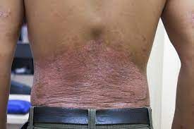 Remède pour Guérir le Psoriasis