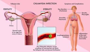 Tisane pour Guérir de la Chlamydia