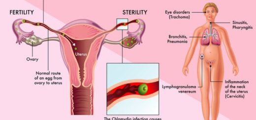 Solution Naturelle Contre la Chlamydia