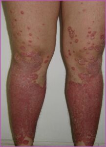 Pommade pour Guérir le Psoriasis Naturellement