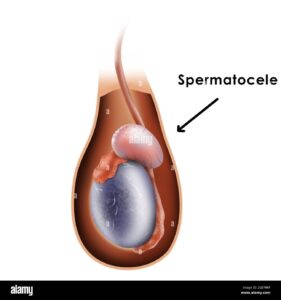 Remède pour Soigner la Spermatocèle