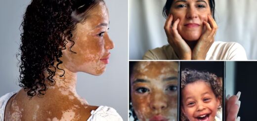 Vitiligo Causes Symptômes Traitement Naturel du Vitiligo