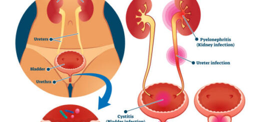 Infection Urinaire Causes Symptômes Prévention Solution Naturelle