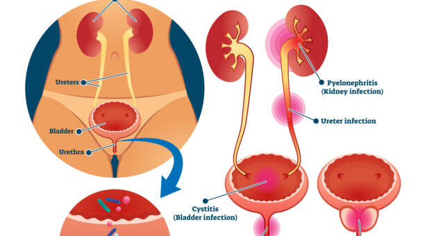 Infection Urinaire Causes Symptômes Prévention Solution Naturelle