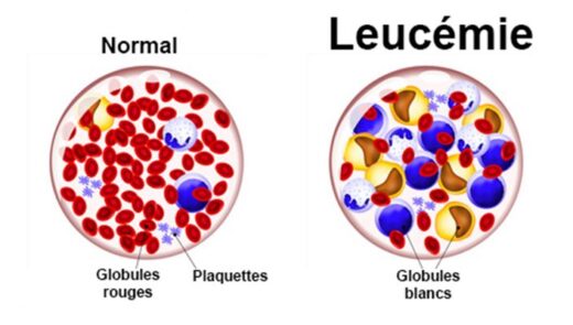 Leucémie Diagnostic Solution Naturelle