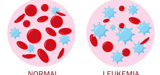 Leucémie Causes Symptômes Diagnostic et Thérapie Naturelle