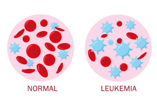 Leucémie Causes Symptômes Diagnostic et Thérapie Naturelle