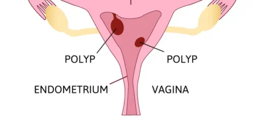 Polype Utérin Causes Symptômes Thérapie Naturelle contre les Polypes Utérins