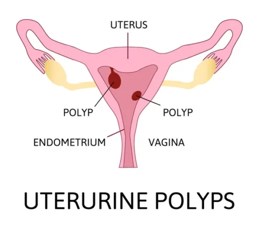 Polype Utérin Causes Symptômes Thérapie Naturelle contre les Polypes Utérins