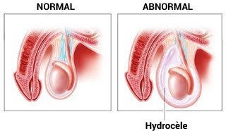 Hydrocèle Testiculaire Solution Naturelle