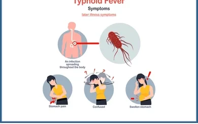 Fièvre Typhoïde Solution Naturelle