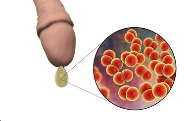 Gonococcie Causes Symptômes Prévention Thérapie Naturelle