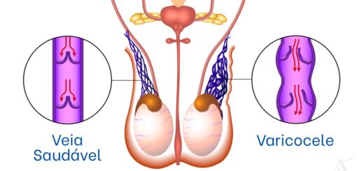 Varicocèle Causes Symptômes Diagnostic Thérapie Naturelle