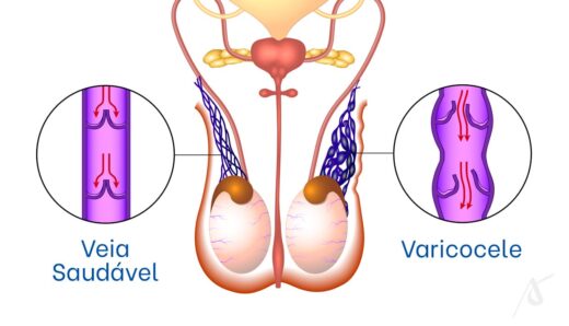Varicocèle Causes Symptômes Diagnostic Thérapie Naturelle