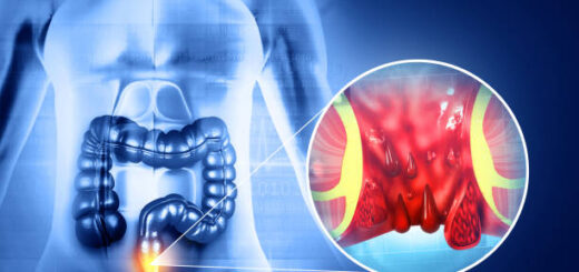 Hémorroïdes Internes Causes Symptômes Traitement Naturel