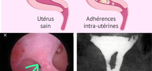 Synechie Utérine Causes Symptômes Diagnostic Remède Naturel