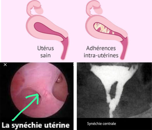 Synechie Utérine Causes Symptômes Diagnostic Remède Naturel