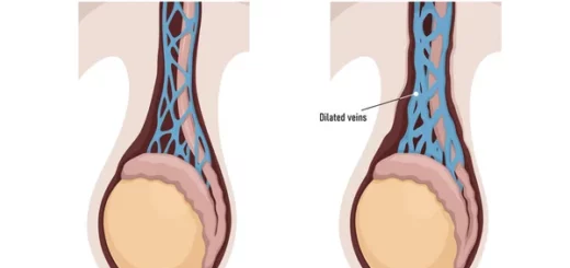 Varicocèle Testiculaire Bilatérale Cause Symptôme Remède Naturel