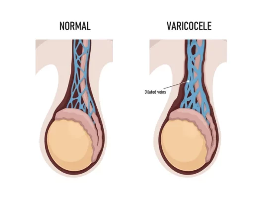 Varicocèle Testiculaire Bilatérale Cause Symptôme Remède Naturel
