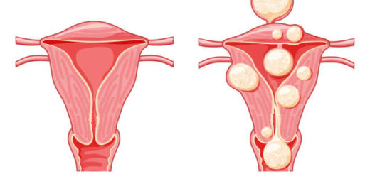 Utérus Polymyomateux Causes et Remède Naturel