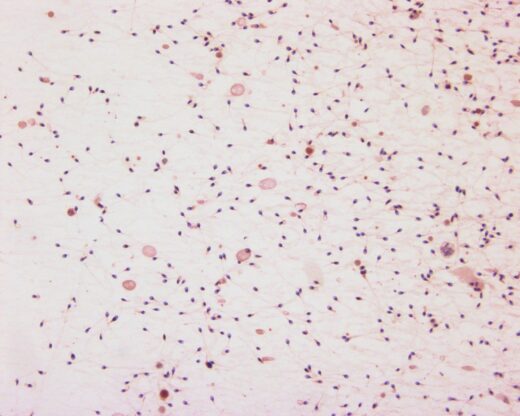 Infertilité Masculine Causes Symptômes Asthénospermie Remède Naturel
