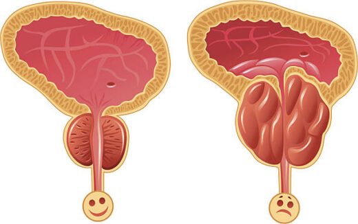 Prostatite Causes Symptômes Remède Naturel Prostatite