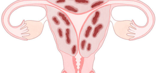 Adénomyose Définition Causes Symptômes Remède Naturel