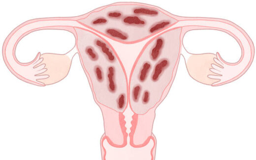 Adénomyose Définition Causes Symptômes Remède Naturel